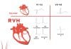 Sağ Ventriküler Hipertrofi (RVH)