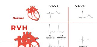 Sağ Ventriküler Hipertrofi (RVH)