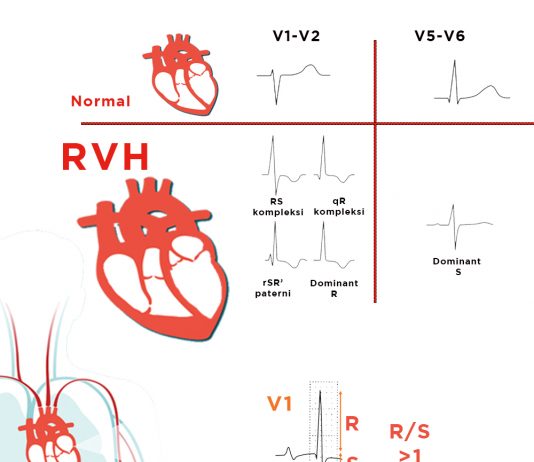 Sağ Ventriküler Hipertrofi (RVH)