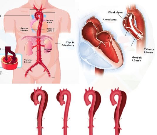 Aort Diseksiyonu
