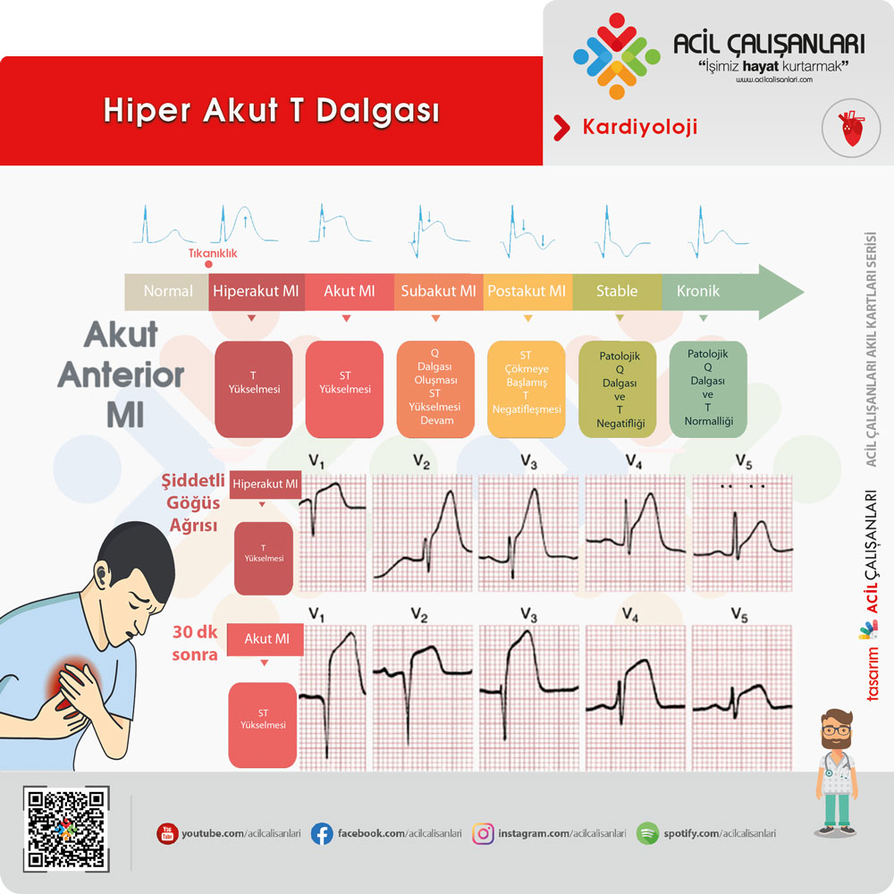 ekg