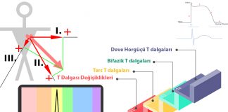 T Dalgası Değişiklikleri