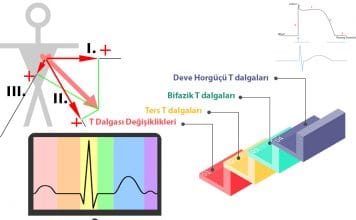 T Dalgası Değişiklikleri