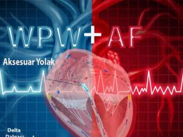 Wolf Parkinson White (WPW) Sendromunda Atriyal Fibrilasyon