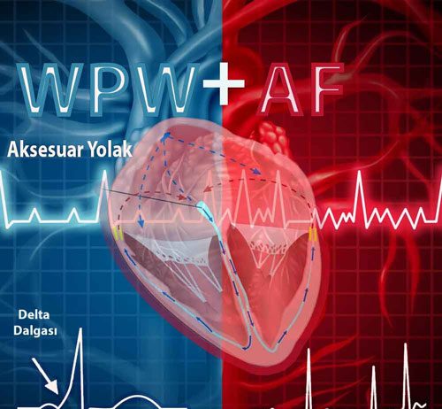 Wolf Parkinson White (WPW) Sendromunda Atriyal Fibrilasyon