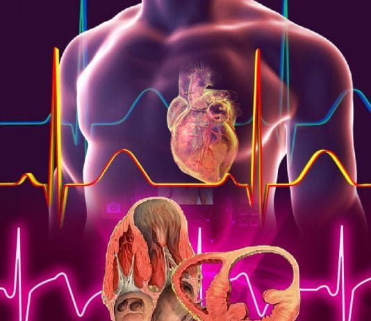 Sol Ventrikül Anevrizması