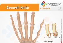 Bennett Kırığı Akıl Kartı