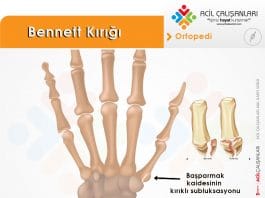 Bennett Kırığı Akıl Kartı