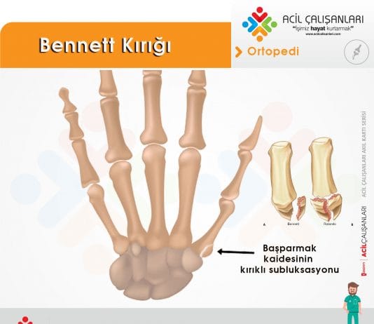 Bennett Kırığı Akıl Kartı