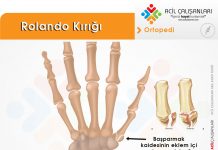 Rolando Kırığı Akıl Kartı