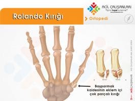 Rolando Kırığı Akıl Kartı