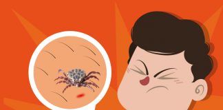 Kırım Kongo Kanamalı Ateşi (KKKA) 45 Yaş Olgu