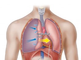 Tansiyon Pnömotoraks Acil Yaklaşım