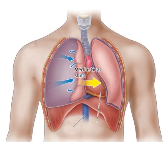 Tansiyon Pnömotoraks Acil Yaklaşım
