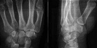 Radial Styloid Kırığı Akıl Kartı