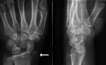 Radial Styloid Kırığı Akıl Kartı