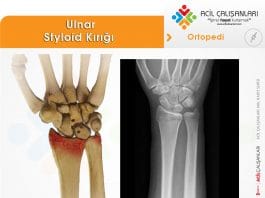 Ulnar Styloid Kırığı Akıl Kartı