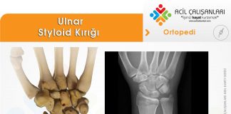 Ulnar Styloid Kırığı Akıl Kartı