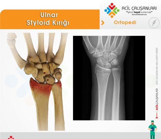 Ulnar Styloid Kırığı Akıl Kartı