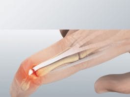Mallet Finger (Çekiç Parmak) Yaralanması
