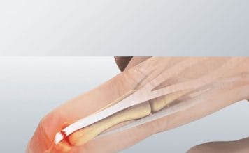 Mallet Finger (Çekiç Parmak) Yaralanması