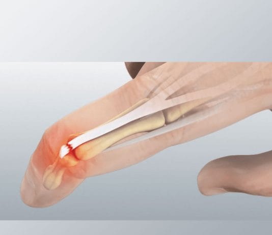 Mallet Finger (Çekiç Parmak) Yaralanması
