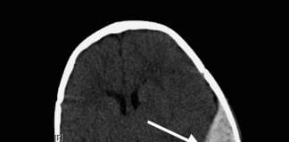 Epidural Kanama Akıl Kartı
