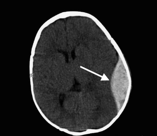 Epidural Kanama Akıl Kartı