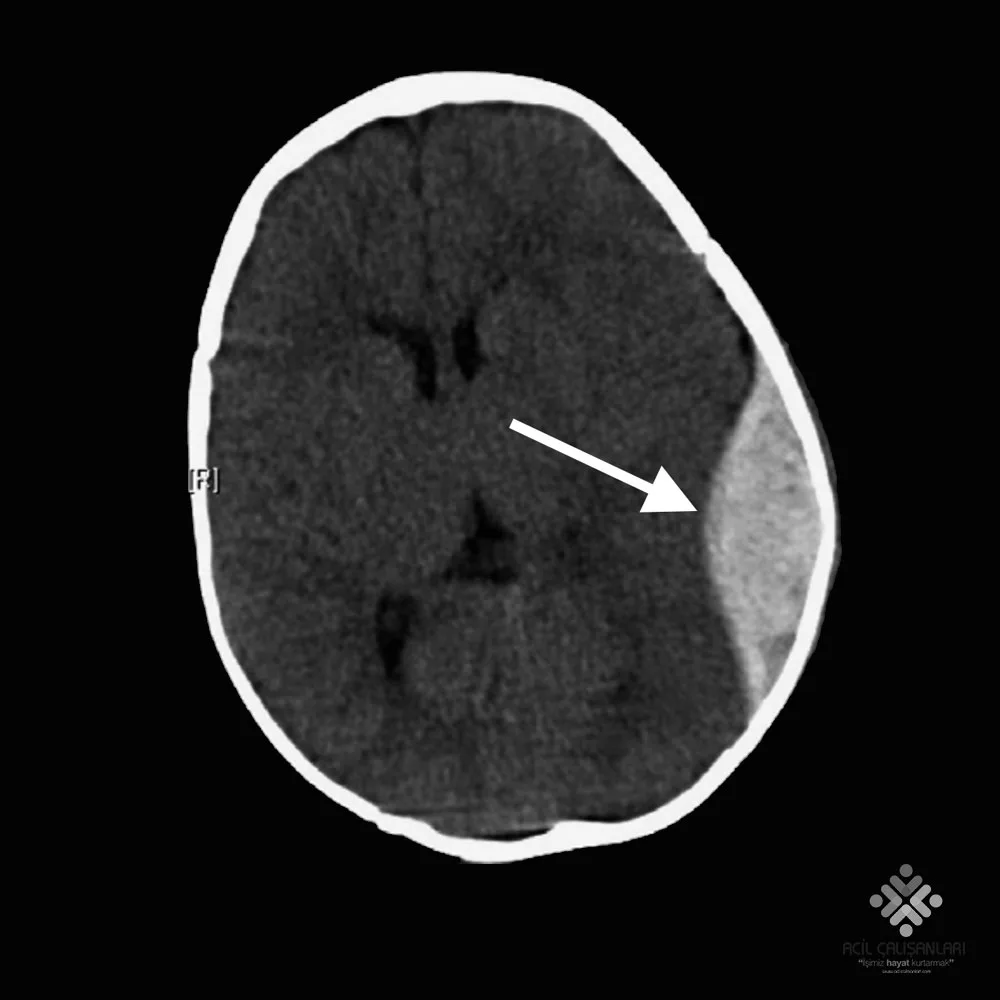Epidural Kanama Akıl Kartı | Acil Çalışanları