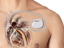 Kalp Pili (Pacemaker)