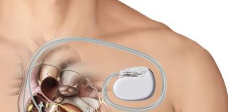 Kalp Pili (Pacemaker)