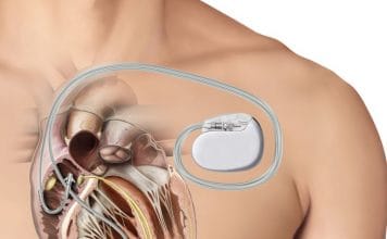 Kalp Pili (Pacemaker)