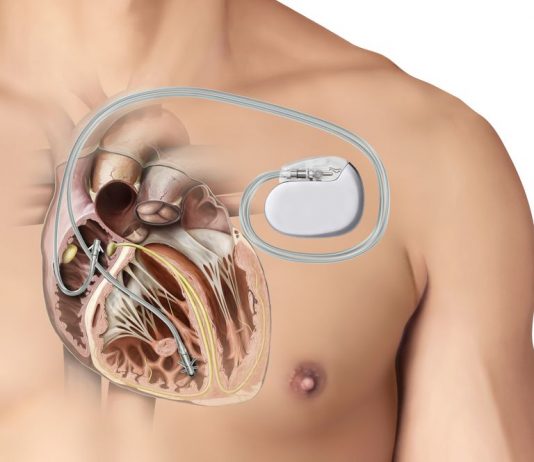 Kalp Pili (Pacemaker)