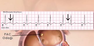 Prematüre Atrial Kompleks (PAC)