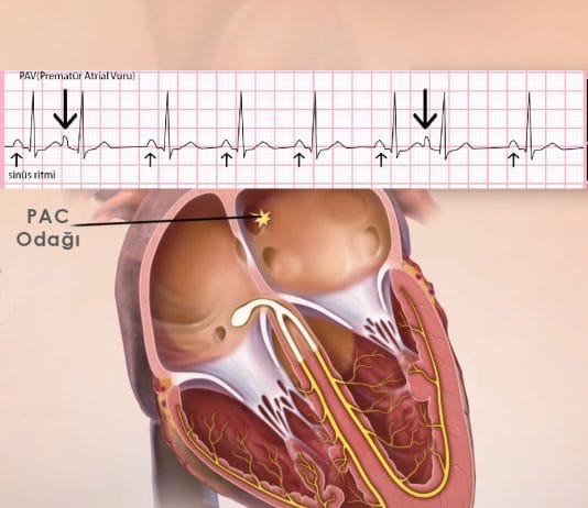 Prematüre Atrial Kompleks (PAC)