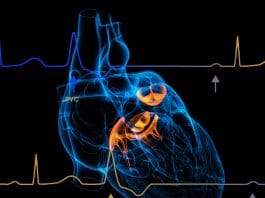 Prematür Ventriküler Kompleks (PVC)