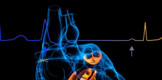 Prematür Ventriküler Kompleks (PVC)