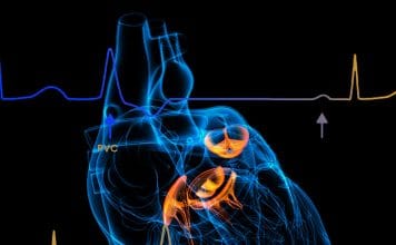 Prematür Ventriküler Kompleks (PVC)