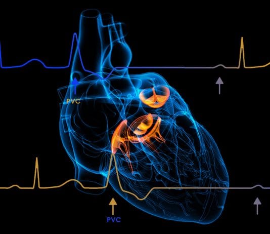 Prematür Ventriküler Kompleks (PVC)