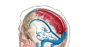 Serebral Ven Trombozu (Sinüs)