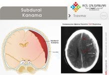 Subdural Kanama Akıl Kartı