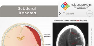 Subdural Kanama Akıl Kartı