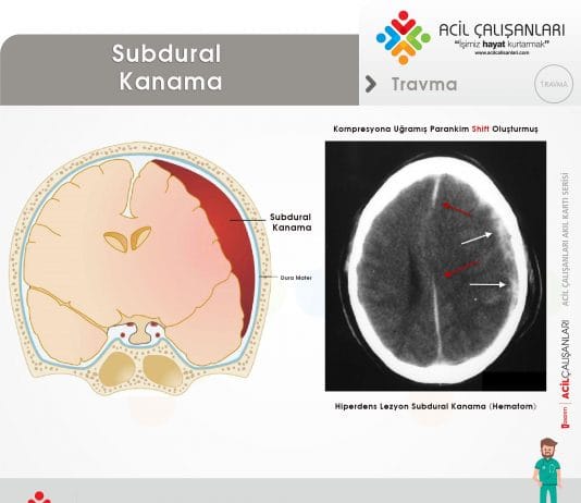 Subdural Kanama Akıl Kartı