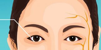 Periferik Fasiyal Paralizi