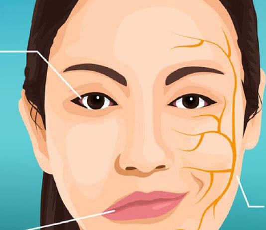 Periferik Fasiyal Paralizi