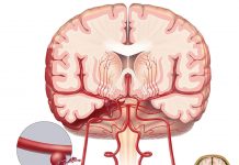 Subaraknoid Kanamaya (SAK) Acil Yaklaşım