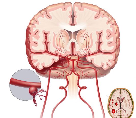 Subaraknoid Kanamaya (SAK) Acil Yaklaşım