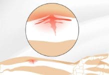 Yeşil Ağaç Kırığı (Greenstick Fracture)