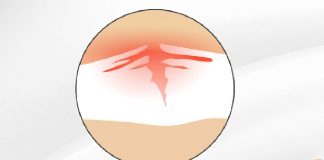 Yeşil Ağaç Kırığı (Greenstick Fracture)