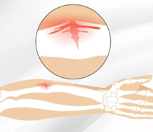 Yeşil Ağaç Kırığı (Greenstick Fracture)